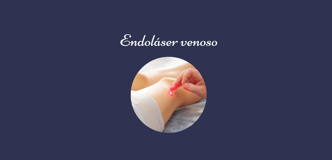 Endolaser venoso para varices