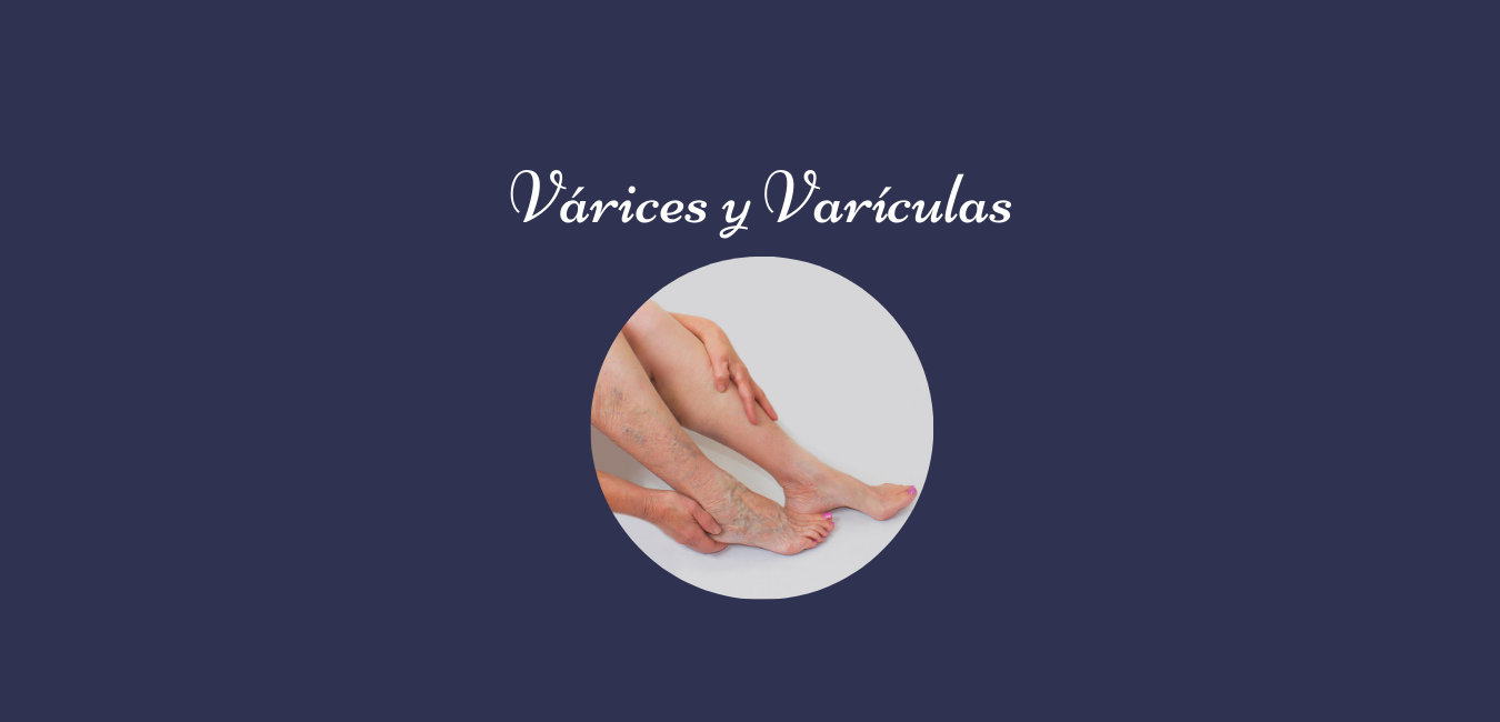 Varicesyvariculas